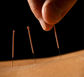 Acupuncture treatment in St Neots and Letchworth