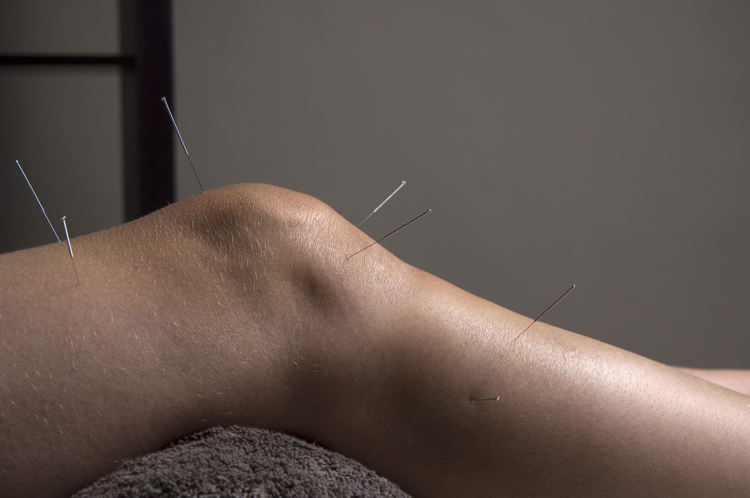 Acupuncture needles inserted on knee and leg.