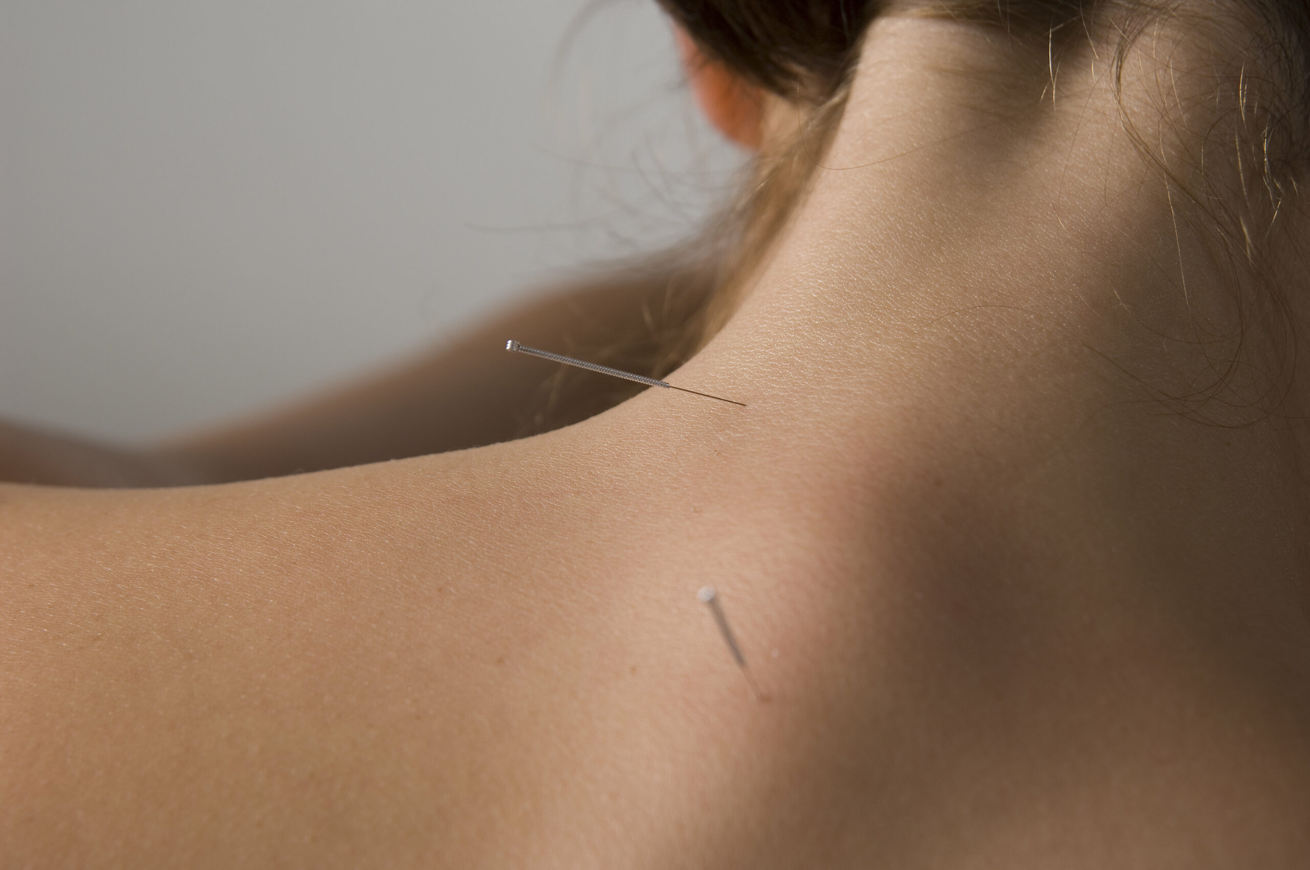 Acupuncture needles inserted into neck.