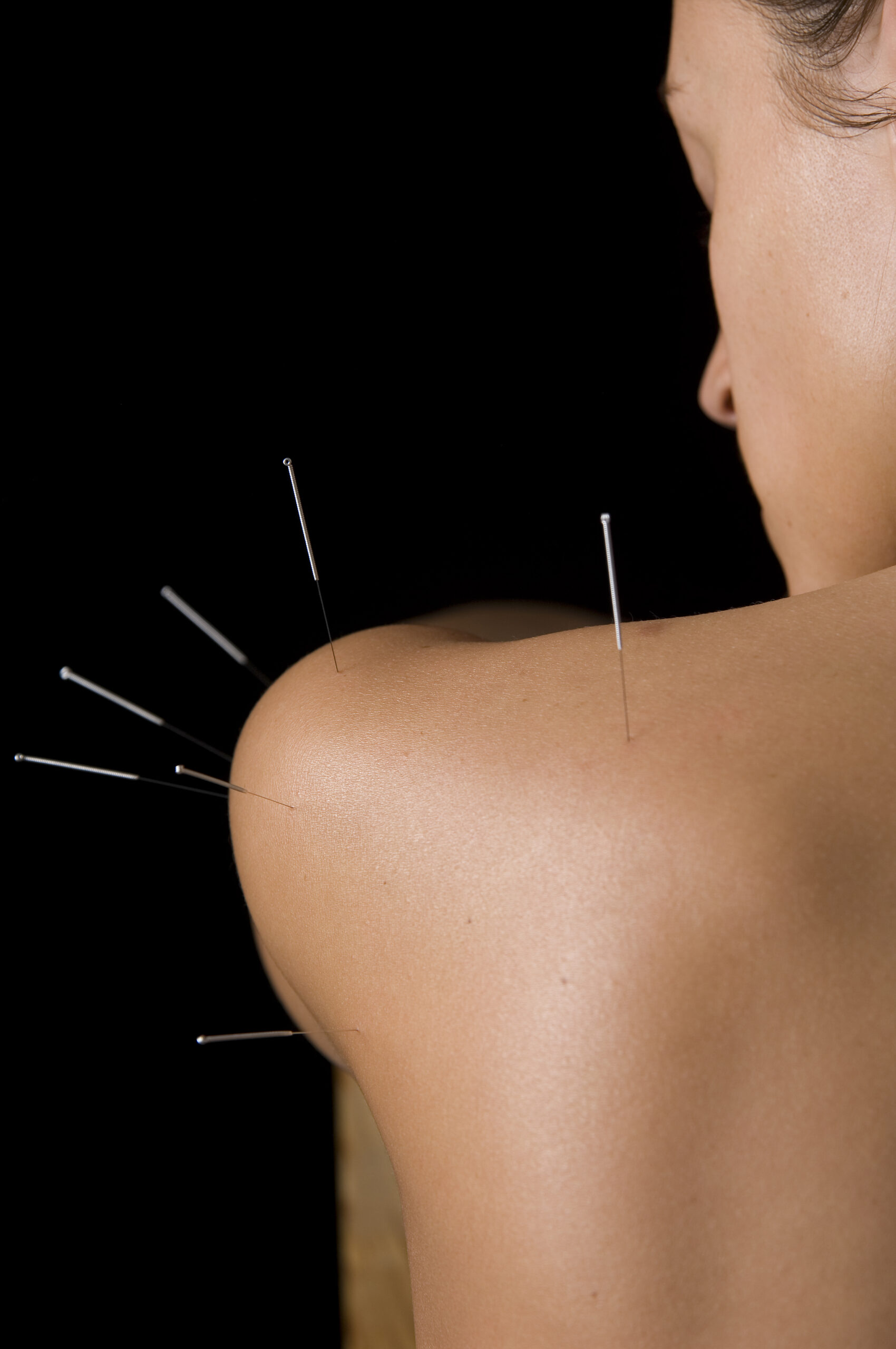 Acupuncture needles inserted on shoulder and upper arm.