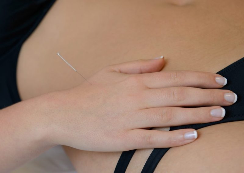 Woman's hand resting on hip with acupuncture needle in LI4 Hegu.